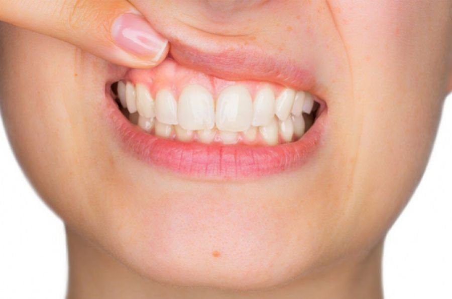 Você conhece as aplicações da Ozonioterapia da periodontia e na implantodontia?