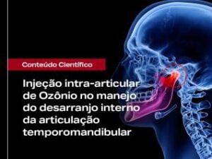 Injeção intra-articular de Ozônio no manejo do desarranjo interno da articulação temporomandibular