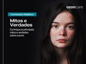 Mitos e verdades sobre a acne