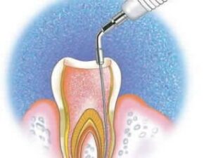 tb ozonioterapia na endodontia 24 9507 Philozon | Geradores de Ozônio