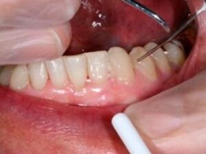 tb ozonioterapia na periodontia 23 161 Philozon | Geradores de Ozônio