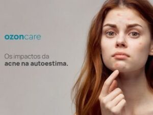 tb os impactos da acne na autoestima 149 8236 Philozon | Geradores de Ozônio