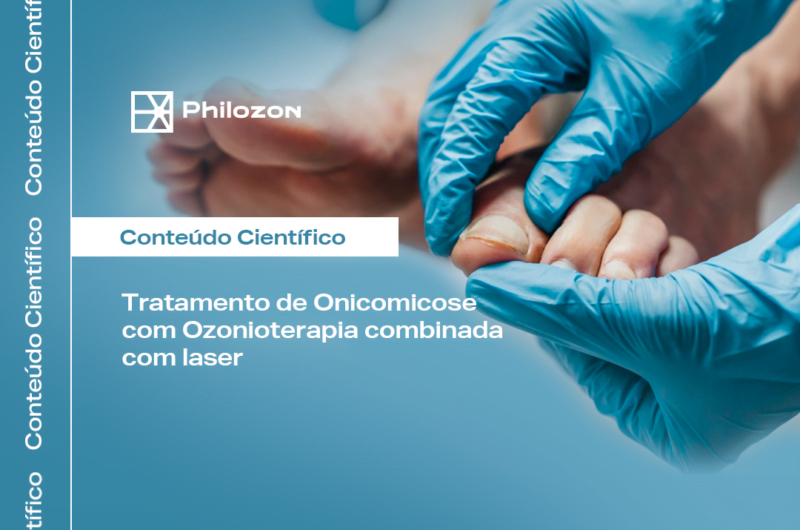 Tratamento de Onicomicose com Ozonioterapia combinada com laser Philozon | Geradores de Ozônio