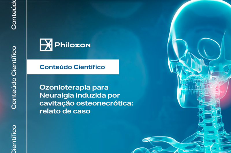 Ozonioterapia para Neuralgia Induzida por cavitacao osteonecrotica Philozon | Geradores de Ozônio