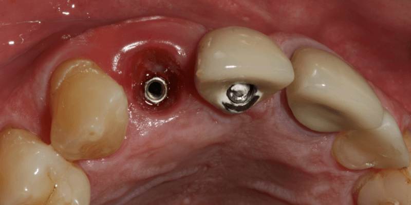Perimplantite 1.1 Philozon | Geradores de Ozônio