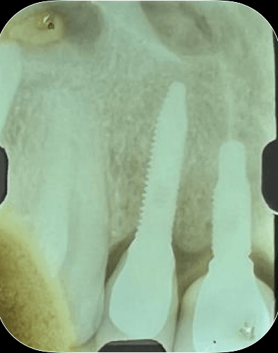 Perimplantite 1 Philozon | Geradores de Ozônio