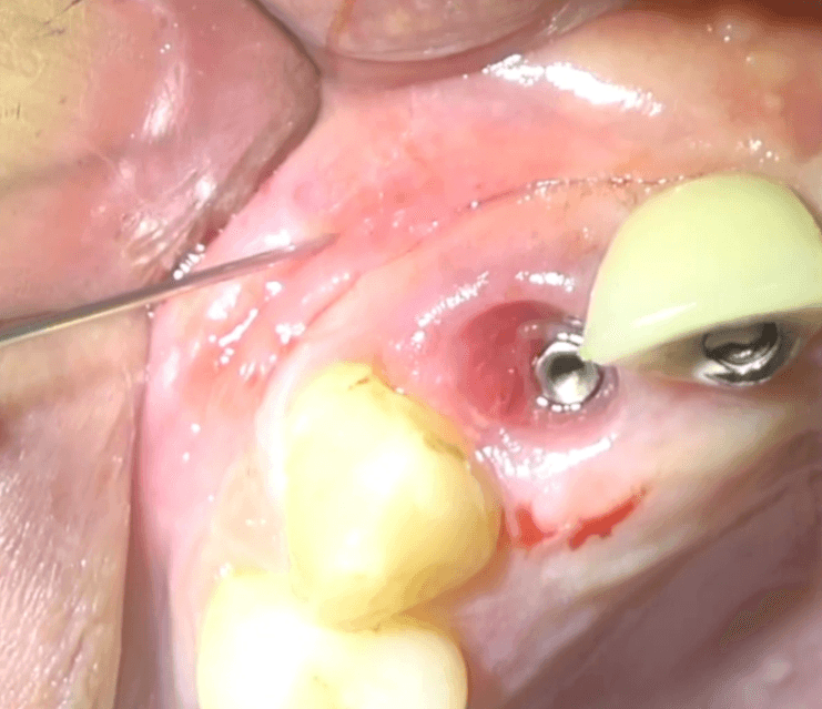Perimplantite 2 Philozon | Geradores de Ozônio