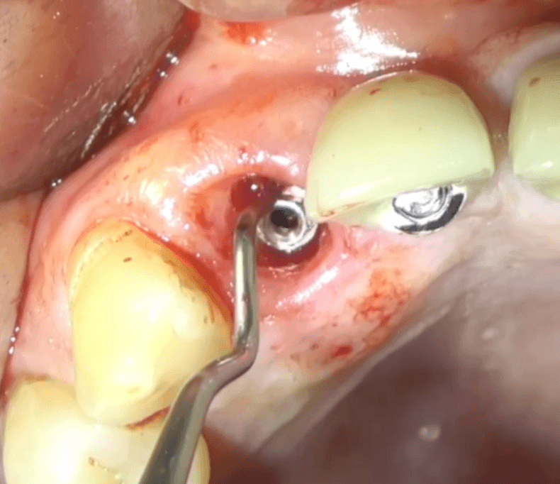 Perimplantite 5 Philozon | Geradores de Ozônio