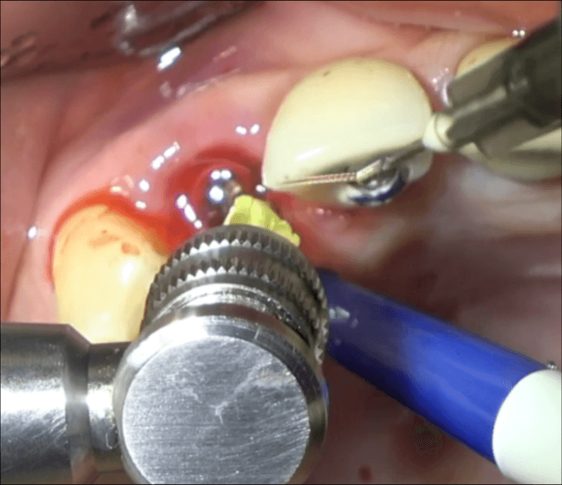 Perimplantite 6 Philozon | Geradores de Ozônio