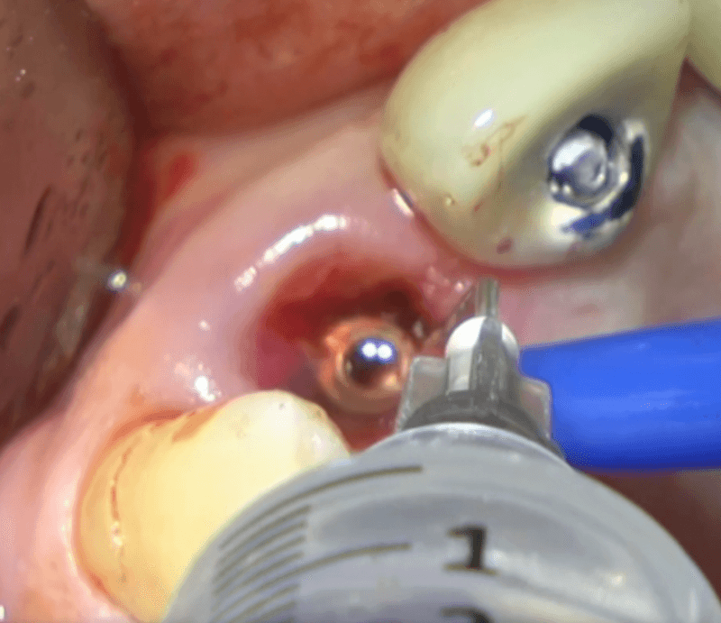 Perimplantite 7 Philozon | Geradores de Ozônio