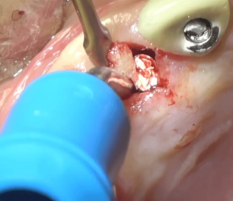 Perimplantite 8 Philozon | Geradores de Ozônio