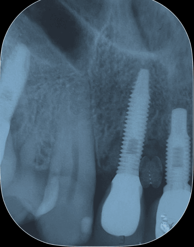 Perimplantite Resultado Philozon | Geradores de Ozônio