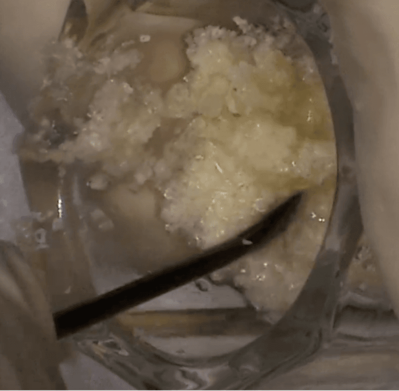 Aglutinação de substitutos ósseos com água ozonizada: relato de caso do Prof. Rafael Manfro 4 Philozon | Geradores de Ozônio implantes1 Philozon | Geradores de Ozônio