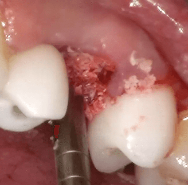Aglutinação de substitutos ósseos com água ozonizada: relato de caso do Prof. Rafael Manfro 3 Philozon | Geradores de Ozônio implantes2 Philozon | Geradores de Ozônio