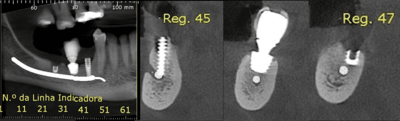 Ozonioterapia como estratégia complementar para reduzir o risco de parestesia na remoção de implantes mandibulares 2 Philozon | Geradores de Ozônio artigo3 Philozon | Geradores de Ozônio