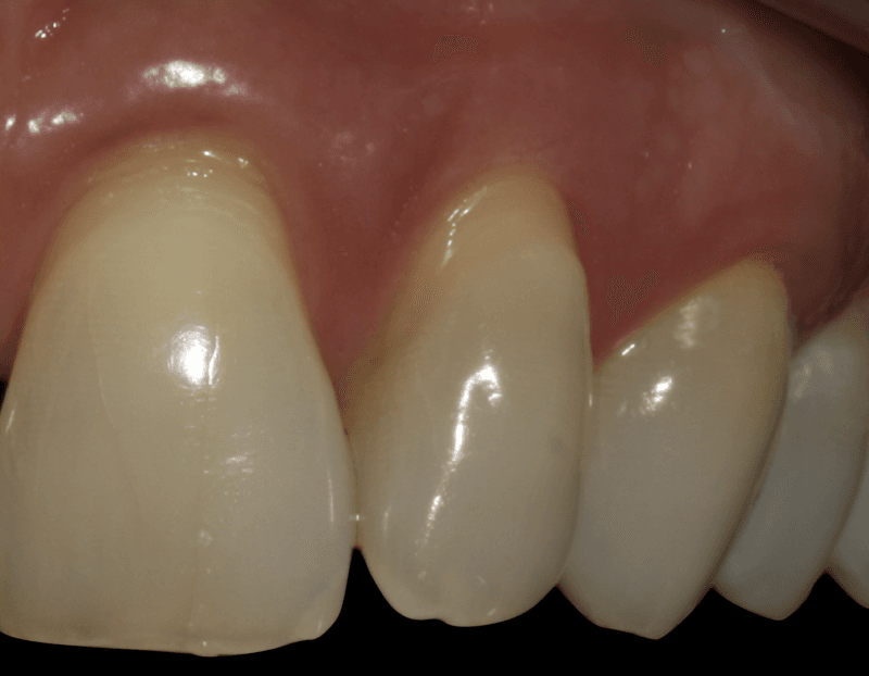 Descontaminação do Alvéolo com Ozônio em Implante 2 Philozon | Geradores de Ozônio dente Philozon | Geradores de Ozônio